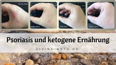 Mehr über den Artikel erfahren Psoriasis – Wie ketogene Ernährung dabei hilft